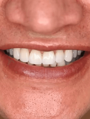 Patient med tandimplantat och veneers.