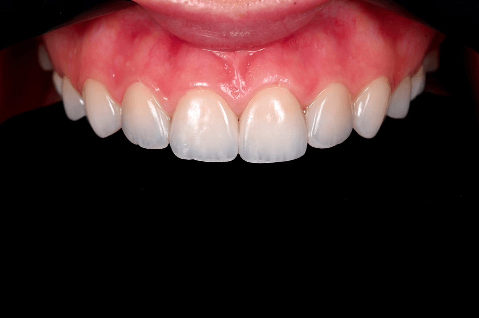 Patient med veneers.