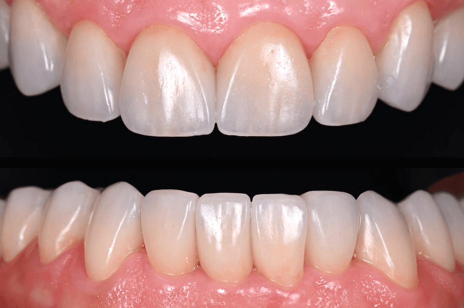 Patient med veneers.