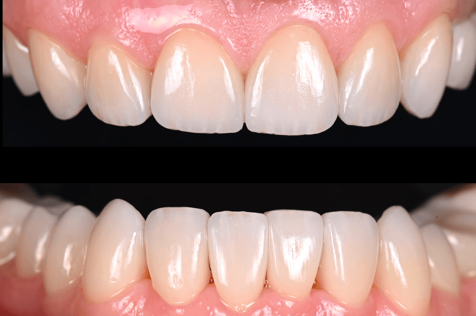 Patient med veneers.