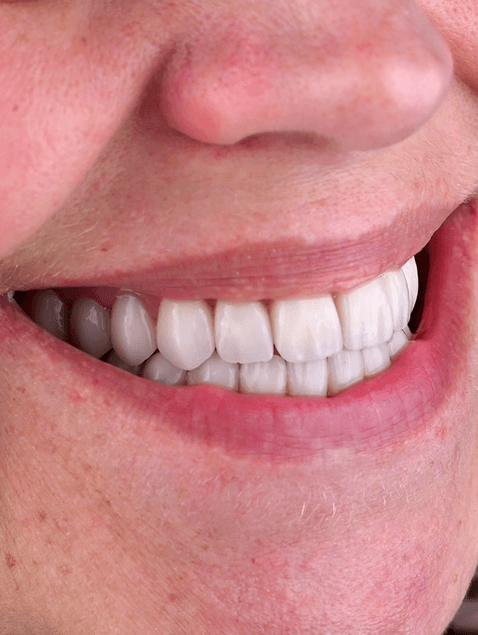 Patient med veneers och allmäntandvård.
