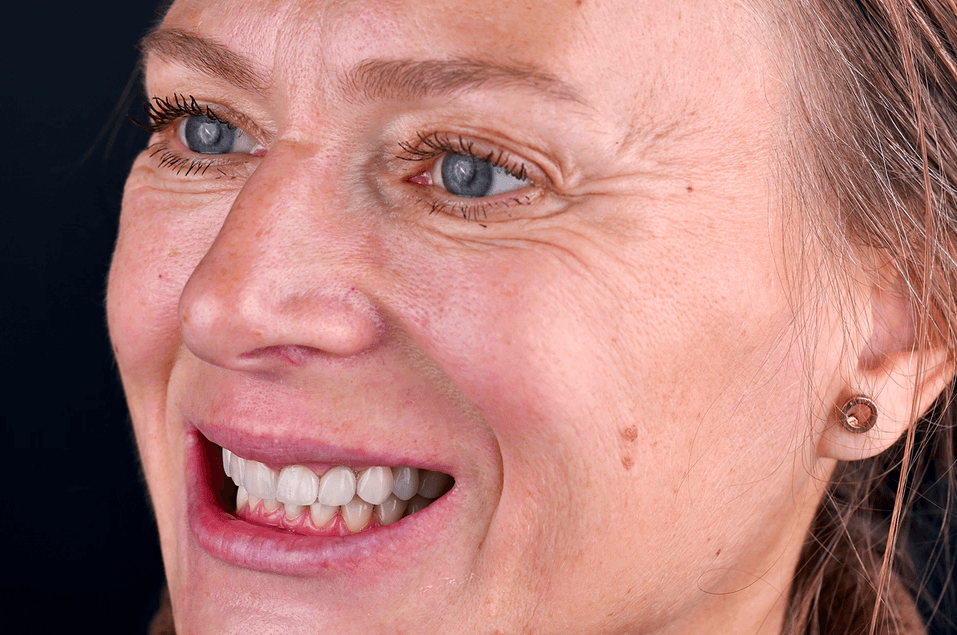 Patient med endodonti och tandimplantat.