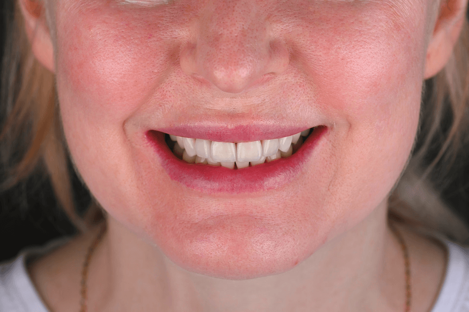 Patient med professionell tandhygien och veneers.